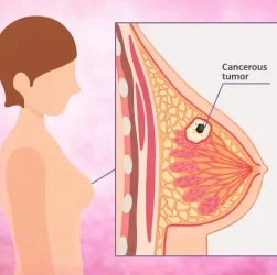 breast-cancer-awareness