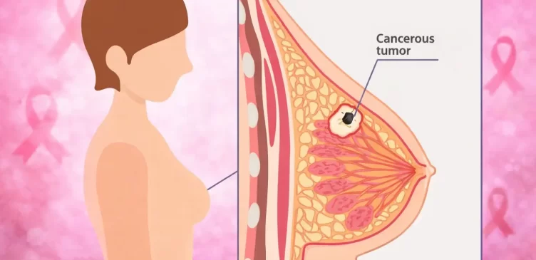 breast-cancer-awareness